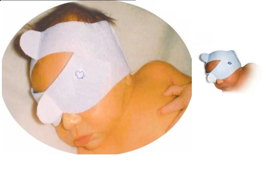 Neonatal Protective Phototherapy Eye Mask