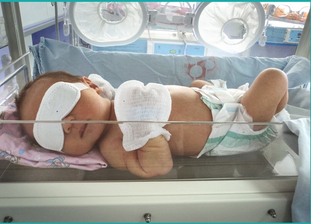 Neonatal Baby Protection Phototherapy gloves